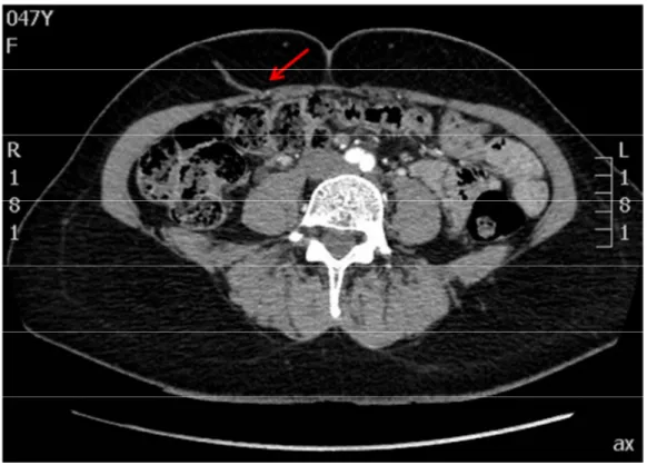 Figure 10 : Angio-scanner préopératoire permettant d'identifier une perforante musculo-cutanée à  droite 