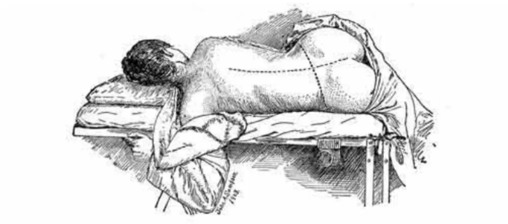 Figure 12 : Dessin tiré du “Gynecology” du Dr Howard Kelly (1928)  montrant la position de Sims 