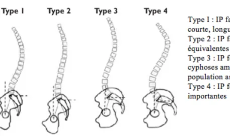 Figure 8. Quatre types de courbures rachidiennes selon Roussouly (73) 