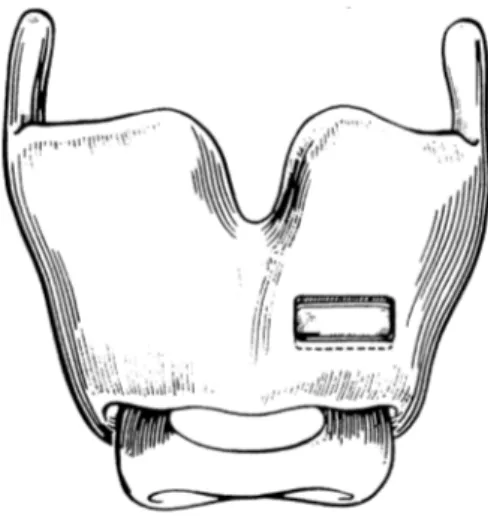 Figure   3   :    thyroplastie   de   type   I   selon   Isshiki,   positionnement   de   la   fenêtre   cartilagineuse   (4)