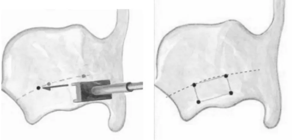Figure   12   :    Définition   des   contours   de   la   fenêtre   cartilagineuse   grâce   au   calibre,   Boston   medical    product
