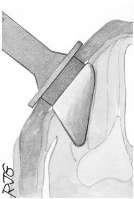 Figure   16   :    implant   définitif   en   place,   Boston   medical   product,        