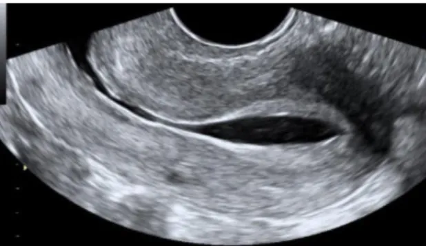 Figure 4  Cavité utérine normale en échographie endo-vaginale 2D avec sérum    physiologique (30) 