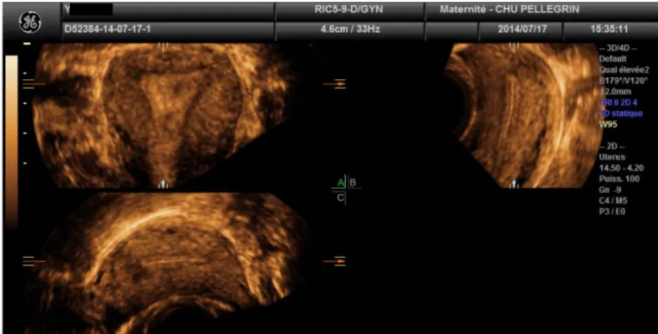 Figure 10  Coupes multiplanaires de l’utérus. Par convention on place : en haut à gauche la  coupe coronale, en haut à droite la coupe sagittale et en bas à gauche la coupe transversale  (iconographie d’un cas de l’étude) 