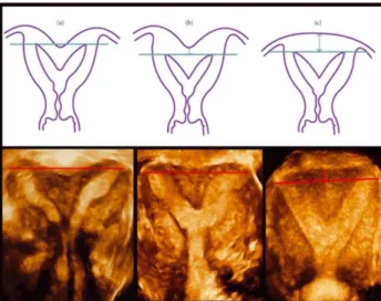 Figure  22    Différenciation  entre  utérus  bicorne  et  cloisonné  selon  la  profondeur  de  l’incisure par rapport à la ligne inter-ostiale en échographie 3D 