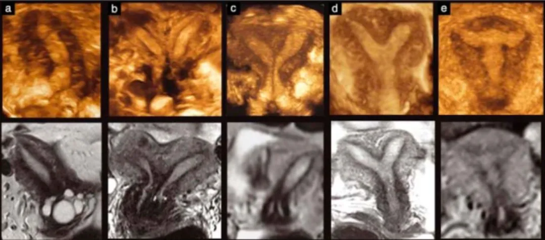 Figure 24  Comparaison de l’échographie 3D et de l’IRM dans le diagnostic de 