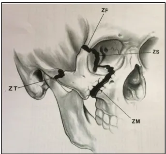 Figure 8 : Lignes de fracture des disjonctions zygomatiques, (source Rigid fixation of malar  fractures Eric F