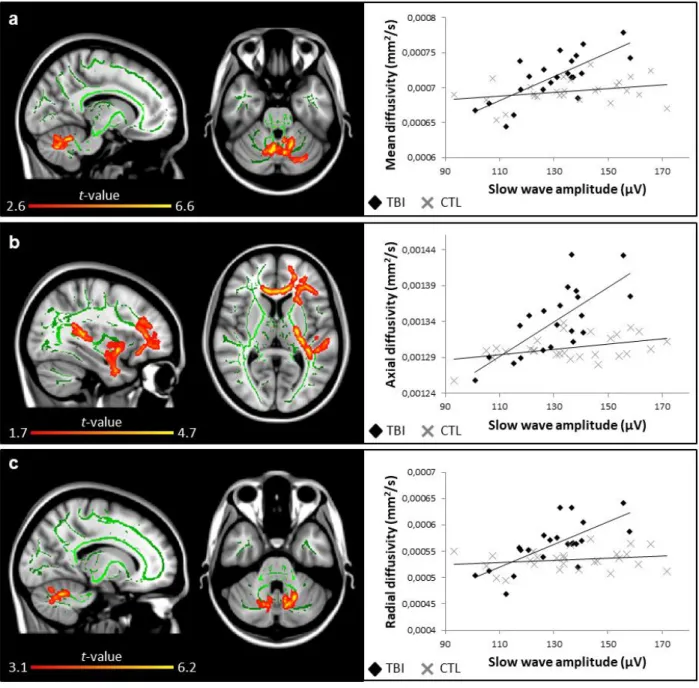 FIGURE 2. Slow wave amplitude and white matter damage. Areas in traumatic brain injury  (TBI) group where slow wave amplitude is positively correlated (red to yellow colored areas) with  (a) mean diffusivity (r = 0.81), (b) axial diffusivity (r = 0.74), an