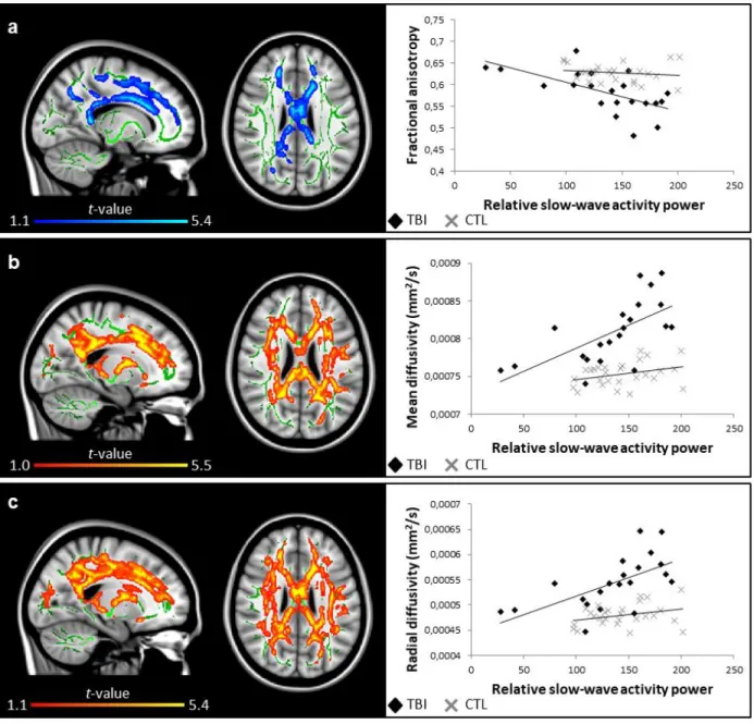 FIGURE 5. Relative slow-wave activity power in the 1 st  sleep cycle and white matter damage