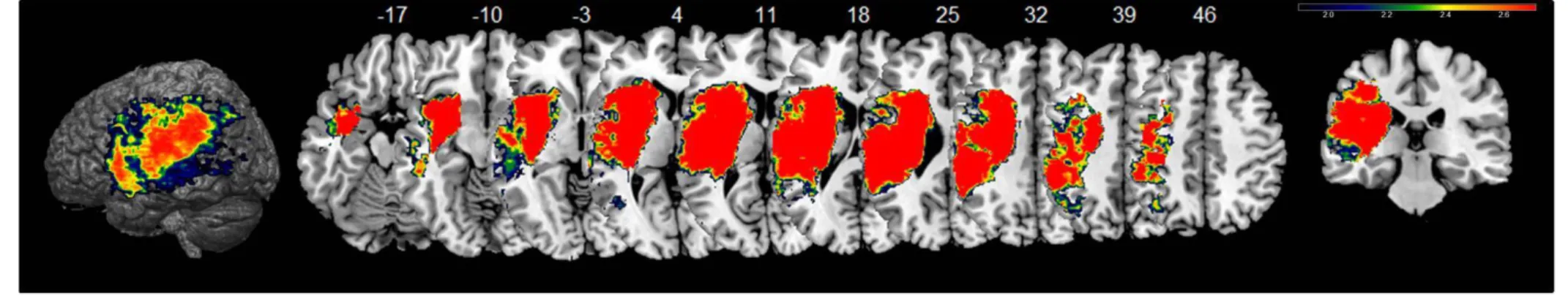 Figure  1:  aphasia  outcome  of  all  patients.  VLSM-maps  showing  lesions  significantly  associated  with  poor  outcome  assessed  by  the  Aphasia  Severity  Rating  Scale  6  month  after  the  stroke  (ASRS&lt;4)