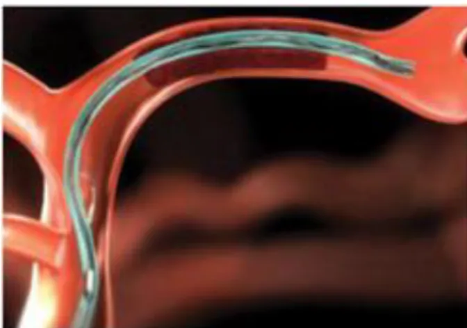 Figure 1 Franchissement du thrombus par le microcathéter 