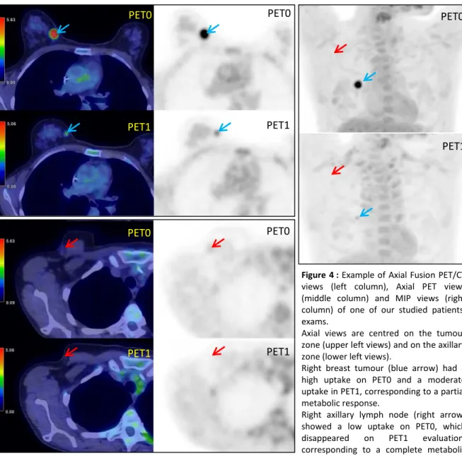 Figure 4 : Example of Axial Fusion PET/CT  views  (left  column),  Axial  PET  views  (middle  column)  and  MIP  views  (right  column)  of  one  of  our  studied  patients’ 