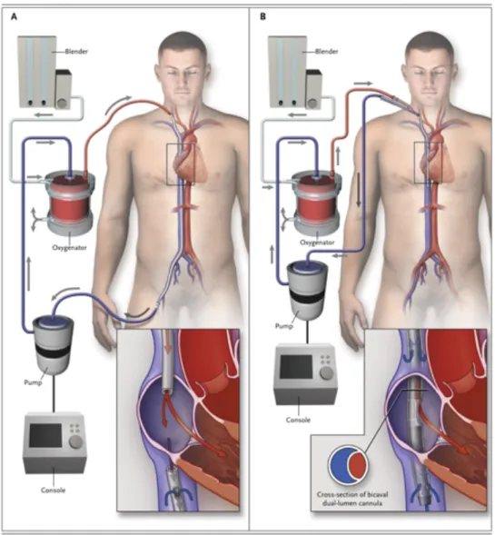 Figure 5 schéma d'ECMO veino veineuse, double canulation fémoro-jugulaire à gauche, canulation simple double  lumière à droite