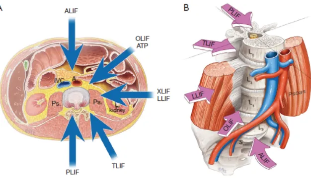 Figure 15 : abords chirurgicaux du rachis lombaire pour fusion intervertébrale (109) 