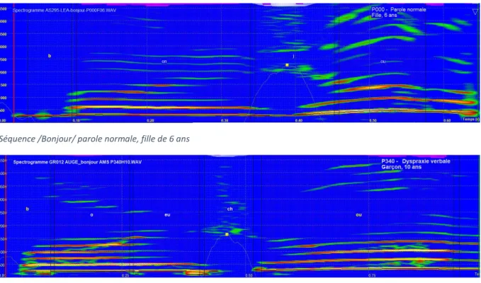 Figure 1 : segmentation du mot /Bonjour/, parole normale (en haut) et altérée (en bas) 
