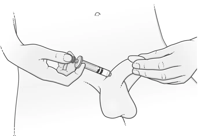 Figure 2 – Schéma d’illustration de la technique de l’injection intra-caverneuse 