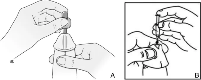 Figure 3- Schéma de principe présentant la mise en œuvre des prostaglandines intra-urétrales 