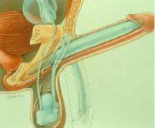Figure 6 - Schéma de présentation d'un implant pénien gonflable (17) 