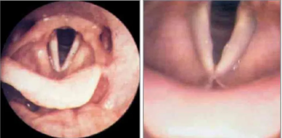 Figure 1 :  Deux photos de plis vocaux : à gauche, plis vocaux sains et à droite plis vocaux atteints de 