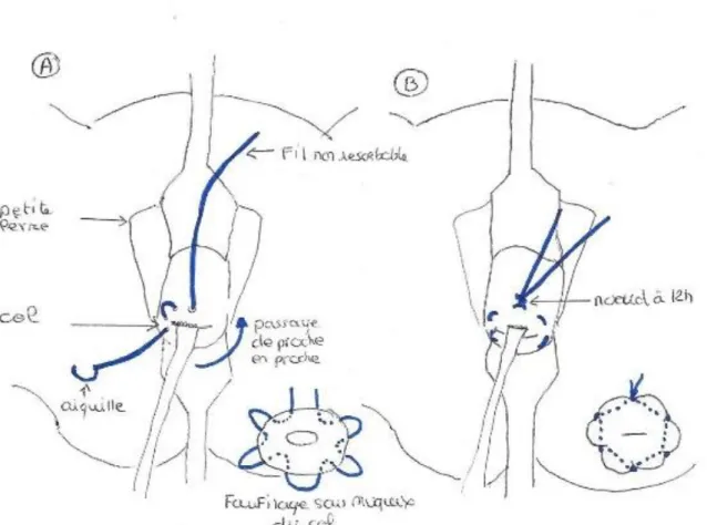 Figure 1 : Cerclage du col utérin selon la technique de McDonald modifiée par Hervet  