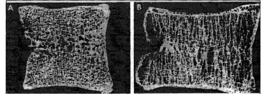 Figure 1.12 Diminution de la qualité osseuse associée  à  l'âge dans un corps vertébral