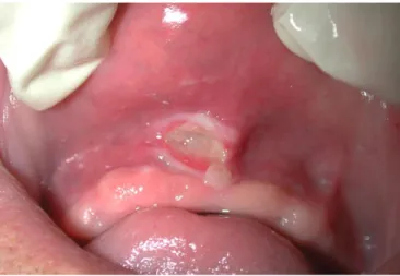 Figure 3 : Ulcération traumatique au fond du vestibule oral antérieur et supérieur chez un patient  porteur de prothèse amovible complète