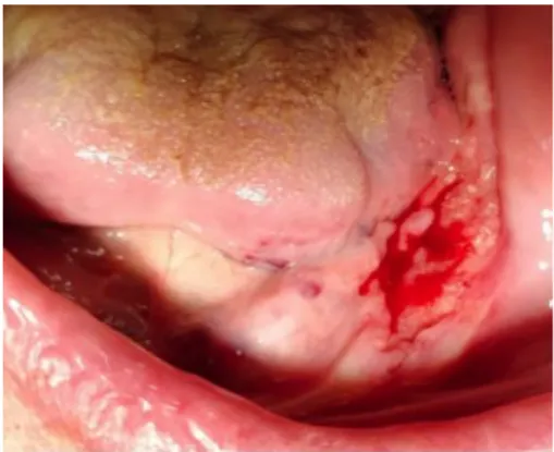 Figure 8 : Carcinome épidermoïde de la gencive mandibulaire gauche. 