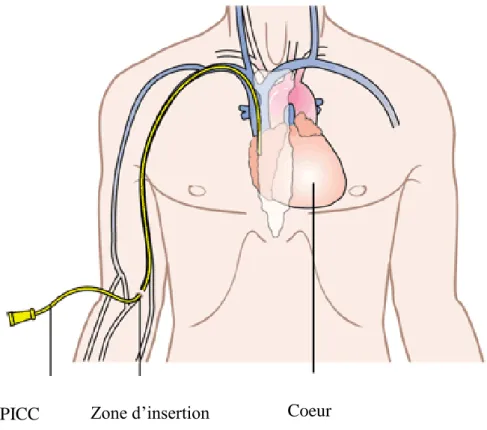 Figure 1 : Trajet d’insertion d’un PICC mis en place dans la veine basilique   D’après  http://www.radiologie-montpellier.fr/imageriemedicale/picc-line/ 