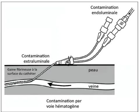 Figure  2  :  les  différentes  modes  de  contamination  des  cathéters  veineux ;  exemple  avec  un  cathéter veineux central (28)
