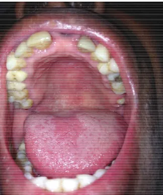 Figure 2 : Photographie illustrant une candidose orale de type pseudo-membraneuse (Service Odontologie du Pr Descroix -  Hôpital Pitié Salpêtrière, Dr Rochefort) 