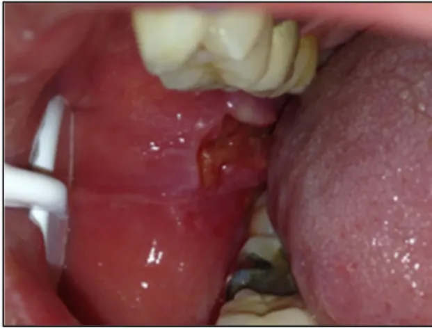 Figure 3: Photographie illustrant un carcinome épidermoïde de stade 2 au niveau de la face interne de la joue droite (Service  Odontologie du Pr Descroix, - Hôpital Pitié Salpêtrière, Dr Rochefort)