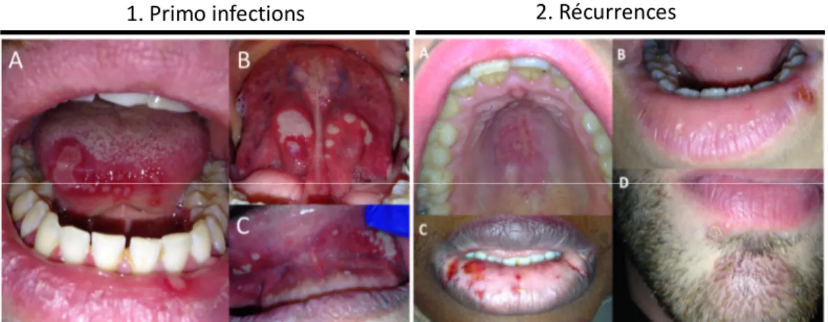 Figure 5 : Photographies illustrant, (1) exemples de primo-infections herpétiques et (2) exemples de récurrences herpétiques  orales (Dr Rochefort, ID 2017) 
