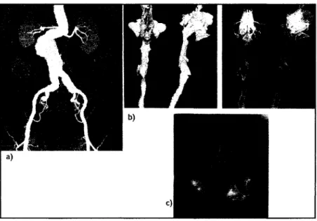 Figure 6- a) Projection MIP b) Reconstruction 3D c) Endoscopie virtuelle (Prokop et  Galanski,  2003) 
