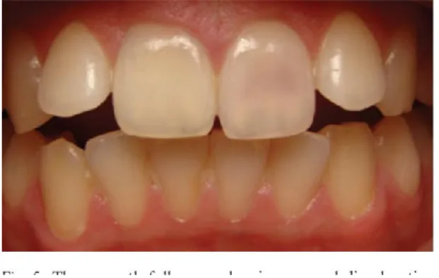 Figure 3. Photographie d’un « pink spot » sur une incisive maxillaire 