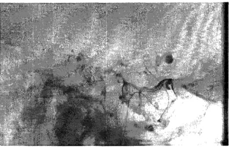 Figure 15  Image fluoroscopique non recalée 