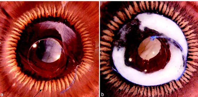 Figure 3. Aspect macroscopique du corps ciliaire sur yeux de cadavres humains d’après Ollerton et al 7 Photographie d’une vue postérieure de segment antérieur (Miyake-Apple view) de deux yeux pseudophakes (a,b)