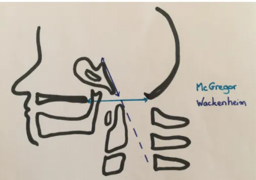 Figure 18 : Ligne de McGregor et de Wackenheim 