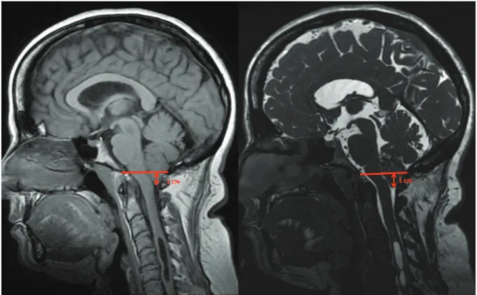 Figure 2 : Diagnostic de malformation de Chiari avec syringomyélie en IRM pondérée en T1  (à gauche) et T2 (à droite) en coupe sagittale