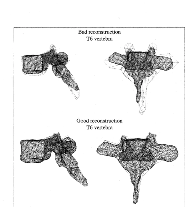 Figure 14  Visual  comparison  between  3D  reconstruction  using  our  3D/2D  registration  method (red lines) and reference CT-scan (black lines) for the T6 vertebra  We note that the results are better for the lumbar vertebrae