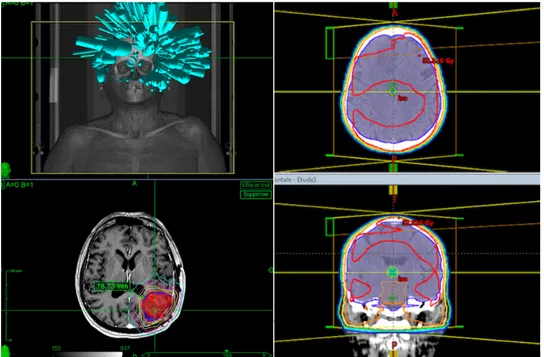 Figure 7 :  Différence entre SRT cérébrale (à gauche) et encéphalique in toto (droite), patients traités  au Centre François Baclesse 