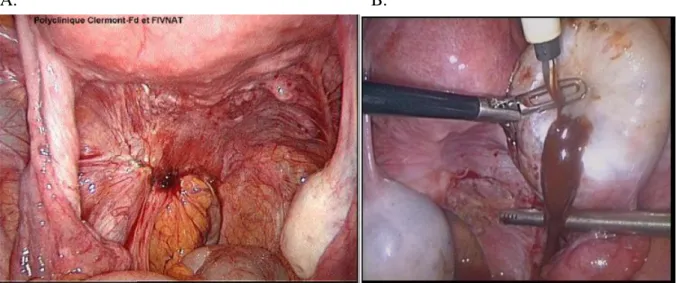 Figure 2 : Différentes topographies des implants endométriosiques. A – Endométriose profonde  du ligament utérosacré gauche