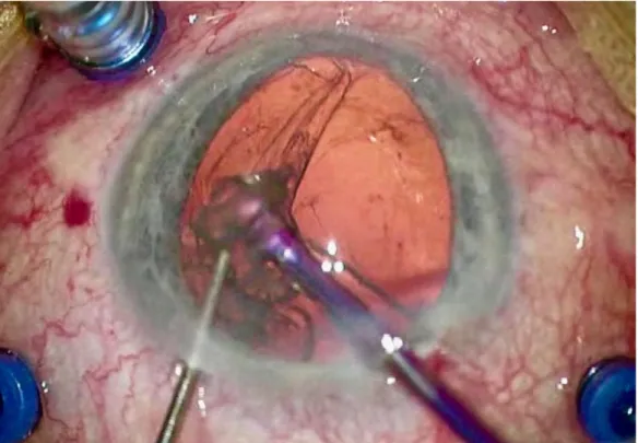 Figure 4 : Rupture capsulaire lors d’une chirurgie de la cataracte  (vidéo du Dr Guigou) 