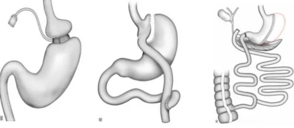 Figure  1.  Les  différents  montages  couramment  utilisés  en  chirurgie  bariatrique