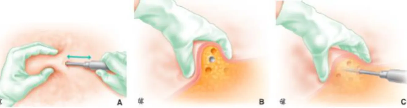 Figure 2. Gestes à effectuer lors d’une lipoaspiration (pour un droitier). La main gauche empaume le tissu adipeux et guide la main droite qui  tunnelise avec la canule (A à C)