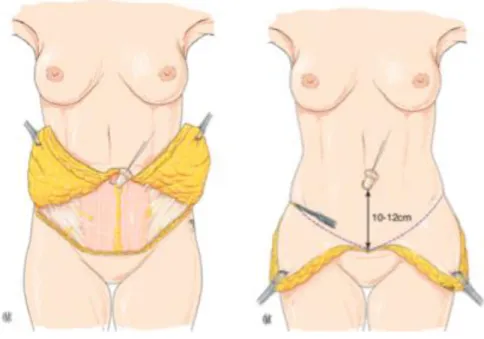 Figure 5. Aspect après décollement sus-aponevrotique. 