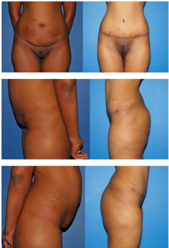 Figure  7.  Photographies pré  et  postopératoires  à  six  mois  d’une  dermolipectomie  abdominale  avec  transposition de  l’ombilic de  face  et de  profil