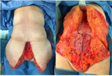 Figure 10. Photographies peropératoires durant le temps antérieur d’une dermolipectomie totale circulaire inférieure avec à gauche l’excès  cutané qui sera réséqué et à droite le décollement sus-aponévrotique permettant de donner de la laxité pour la sutur