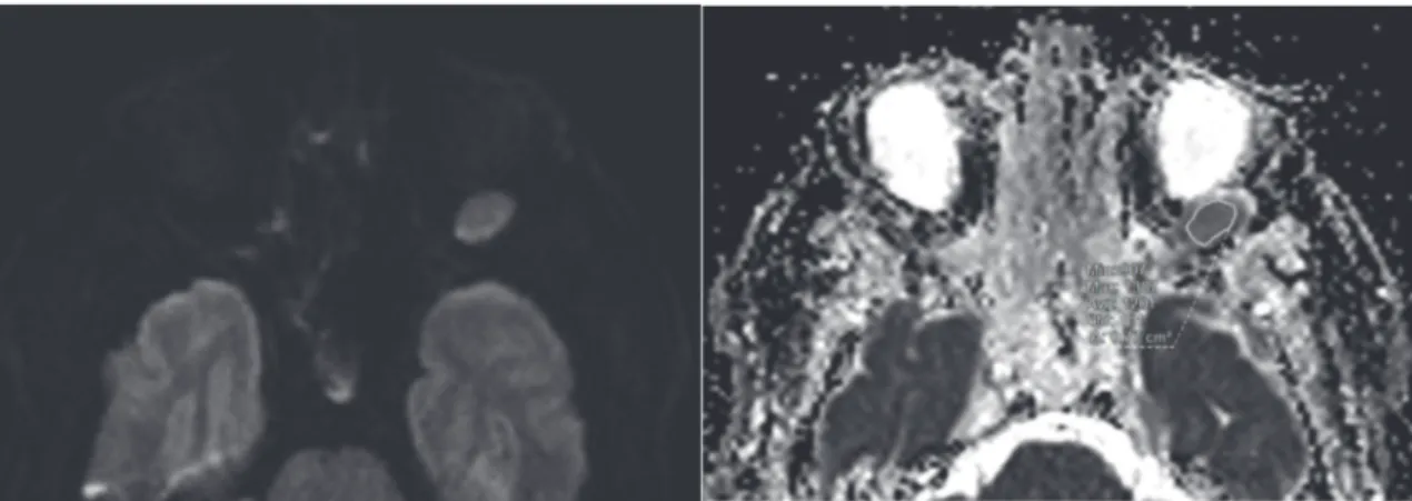 Fig. 6. IRM orbitaire, coupe axiale, patiente de 45 ans porteuse d’une métastase orbitaire