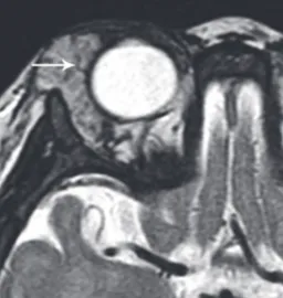 Fig. 11. IRM orbitaire, coupe axiale en T2, hémangiome capillaire chez une petite fille de 7 mois avec  flow voids (flèche)(14) 