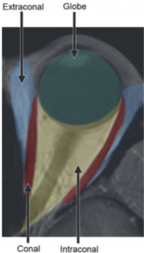 Fig. 12. Anatomie orbitaire normale. Les muscles oculomoteurs (en rouge) délimitent le compartiment  intra conique (en jaune) du compartiment extra conique (en bleu)